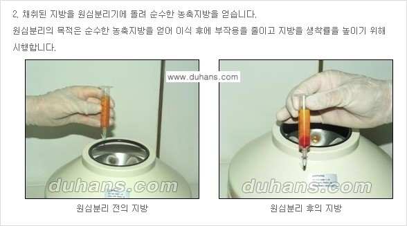 ​​​⁠[두한성형외과 경쟁력 미세지방이식] - [귀족수술 - 입체미세지방이식 ②] 관련 이미지 4