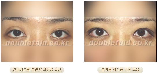[두한성형외과 쌍커플 재수술] - [비절개눈매교정 재수술] 관련 이미지 3