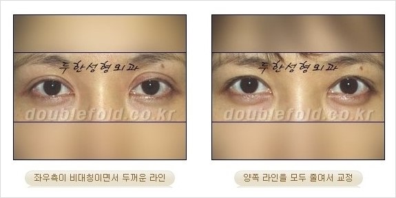 [두한성형외과 경쟁력 쌍꺼풀 재수술] - [짝짝이 쌍꺼풀 라인 교정] 관련 이미지 7