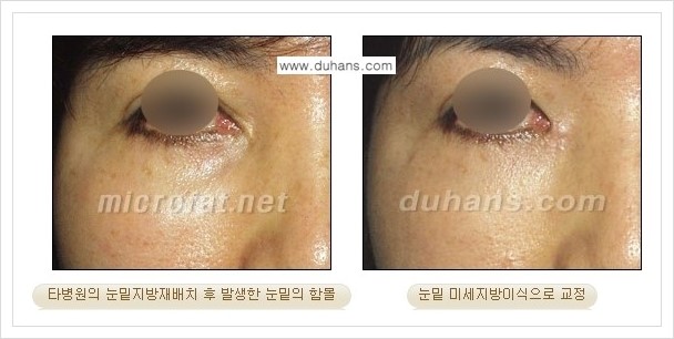 [두한성형외과 경쟁력 눈밑성형] - [과도한 눈밑지방제거의 부작용 후 눈밑지방재배치] 관련 이미지 3