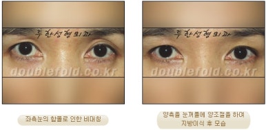 [Duhan Plastic Surgery Eye Surgery] - [Asymmetric Line, Eyelash Eversion, Deep Fixation] image 23
