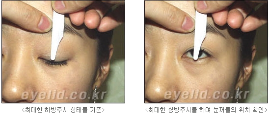 Duhan Plastic Surgery Eye Surgery - Are You a Candidate for Double Eyelid Revision Surgery?! image 4