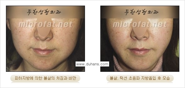 ​[두한성형외과 가을엔 지방흡입을] - [볼살, 눈밑, 턱선 초음파 미세지방흡입] 관련 이미지 2
