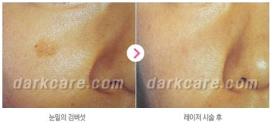 [눈밑수술 두한성형외과] - [다크서클 콤비프로그램] 관련 이미지 164