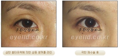 Duhan Plastic Surgery Ophthalmic Reoperation - What Is a Successful Double Eyelid Revision Surgery? image 11