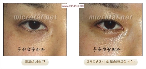 ​﻿[두한성형외과 경쟁력 지방이식] - [눈밑 애교살 시술을 위한 미세지방이식] 관련 이미지 10