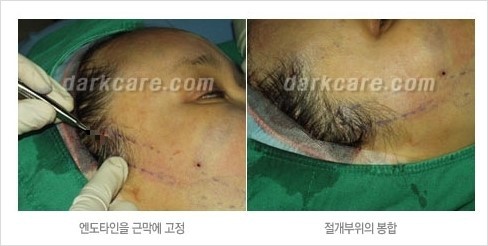 [두한성형외과 주름성형] - [주름교정술 - 강력한 리프팅 파워 엔도타인 리프팅 ] 관련 이미지 12