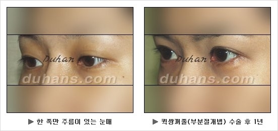[두한성형외과 쌍커풀수술] - [눈성형 방법에 대한 자주하는 질문과 답변] 관련 이미지 124