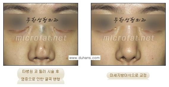 [두한성형외과 경쟁력 Quick 주름성형] - [주름교정을 위한 간편한 필러시술] 관련 이미지 11
