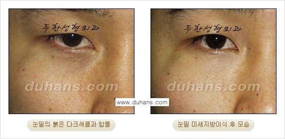 [두한성형외과 상큼하고 환한 눈매완성] - [눈밑 미세지방이식 ②] 관련 이미지 12