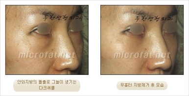 두한성형외과 눈밑수술 - 다크서클 수술 전후 관리 안내 관련 이미지 48