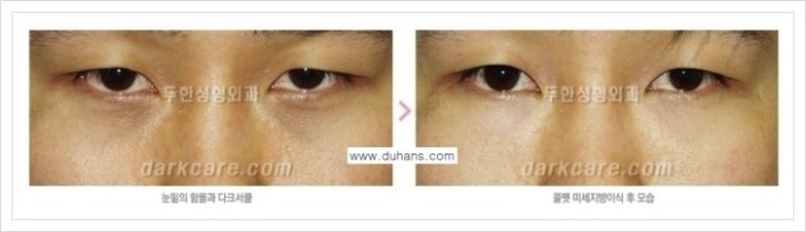 [두한성형외과 경쟁력 눈밑성형] - [눈밑 다크써클 증상과 그 증상에 맞는 치료 방법 안내] 관련 이미지 4
