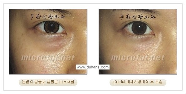[두한성형외과 경쟁력 눈밑성형] - [눈밑 다크써클과 눈밑 함몰주름의 최적화 교정방법 안내] 관련 이미지 24