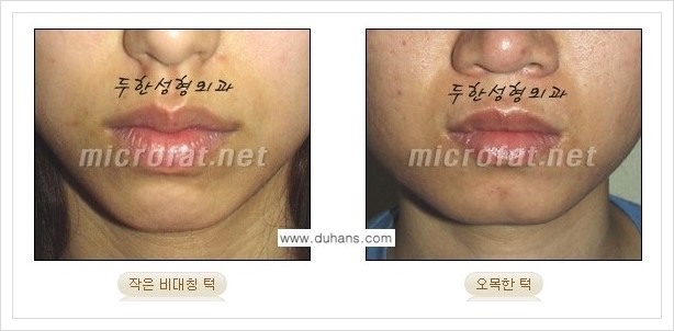 [두한성형외과 경쟁력 미세지방이식] - [얼굴 윤곽 무턱교정 안내 ①] 관련 이미지 2
