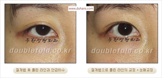 [두한성형외과 경쟁력 눈성형] - [쌍꺼풀 재수술에 대한 최선의 대안 제시] 관련 이미지 81