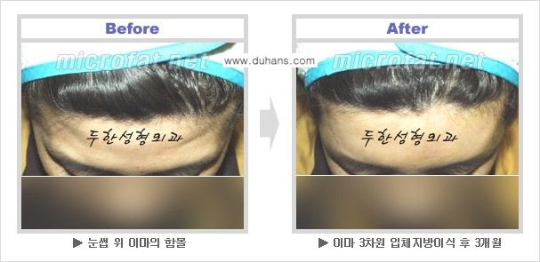 [두한성형외과 NO 1. "Col-fat 지방이식"] - [지방이식의 지속효과, 오해와 진실, 부작용] 관련 이미지 2