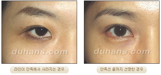 [DuHan Plastic Surgery Eye Surgery] - [Double Eyelid Surgery Guide] image 11