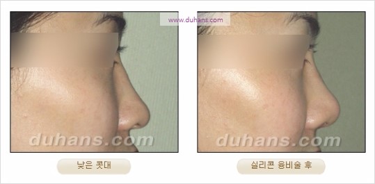 [두한성형외과 경쟁력 코성형 리더] - [자연스럽고 오똑한 콧망울! 코성형 방법]​ 관련 이미지 18