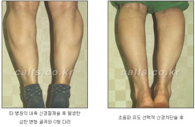 [종아리 두한성형외과] - [나에게 맞는 종아리시술] 관련 이미지 26