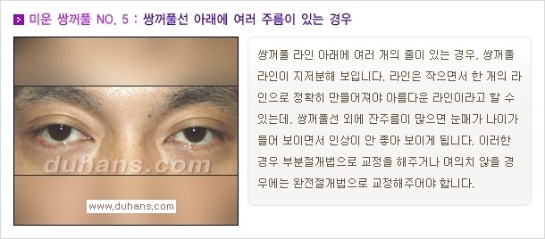 [두한성형외과 경쟁력 쌍꺼풀 재수술, 극한 눈재수술] - [자연스러운 눈매로의 복원 쌍꺼풀 재수술 대상 안내] 관련 이미지 6