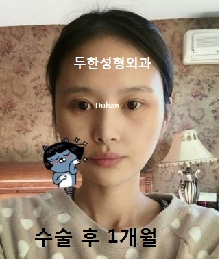 [두한성형외과 쌍커풀수술] - [쌍꺼풀지방이식] 관련 이미지 65