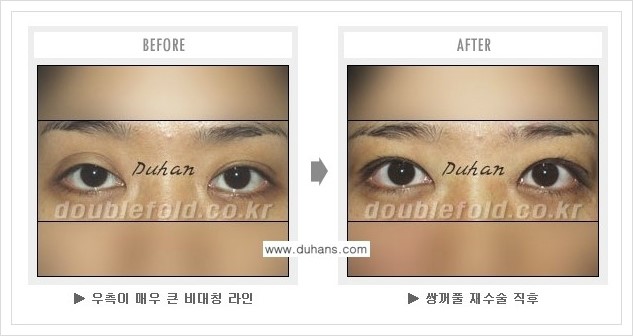 [두한성형외과 경쟁력 쌍꺼풀 재수술(극한 재수술)] - [피부 여유분이 부족해서 토안증이 발생한 경우의 문제점 해결 안내] 관련 이미지 6