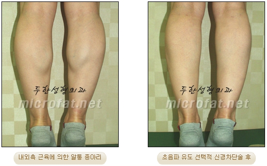 [Duhan Plastic Surgery Clinic Calf Contouring] - [Calf Reduction] image 18