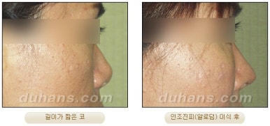 DuHan Plastic Surgery Revision Rhinoplasty - AlloDerm Nose Surgery, SureDerm Nose Surgery image 17