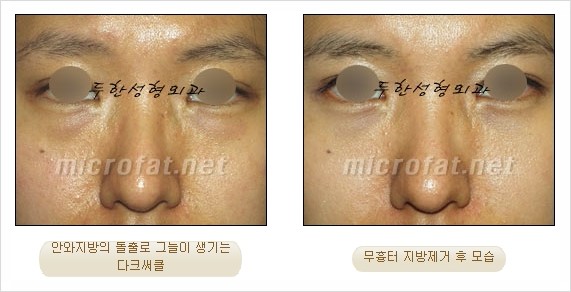 [두한성형외과 쌍커풀수술] - [눈성형 방법에 대한 자주하는 질문과 답변] 관련 이미지 159