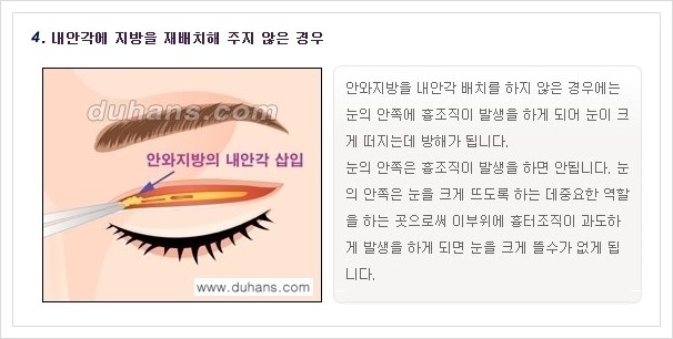 ​​[두한성형외과 경쟁력 쌍꺼풀(눈) 재수술] - [쌍꺼풀(눈) 재수술 실패의 원인 분석 안내] 관련 이미지 6
