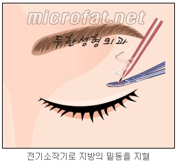 [두한성형외과 지방제거] - [눈밑지방제거, 윗눈꺼풀지방제거] 관련 이미지 58