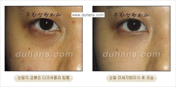 [두한성형외과 경쟁력 미세지방이식] - [다크써클 & 눈밑주름 미세지방이식 5.] 관련 이미지 8