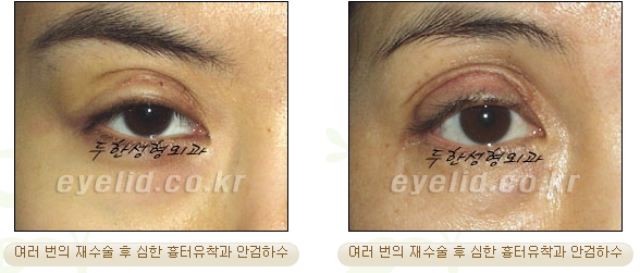Duhan Plastic Surgery Ophthalmic Reoperation - What Is a Successful Double Eyelid Revision Surgery? image 5