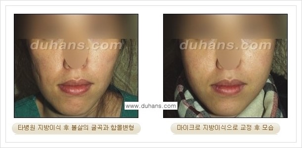 [두한성형외과 경쟁력 얼굴 미세지방이식] - [타병원에서 지방이식 후 굴곡과 과주입 교정 안내] 관련 이미지 3