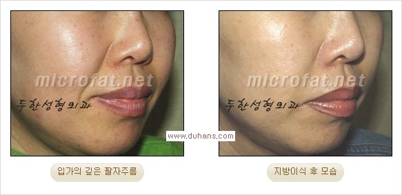 [두한성형외과 경쟁력 주름성형] - [주름 교정을 위한 안전하고 효과적인 미세지방이식] 관련 이미지 14