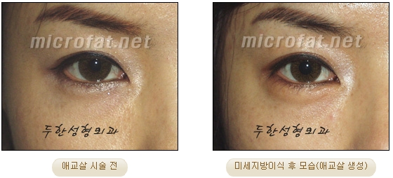 Duhan Plastic Surgery Under-Eye Surgery - Correction with Fat Grafting After Aegyo-Sal Filler image 15