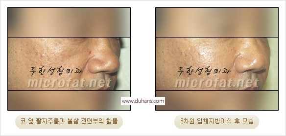 [두한성형외과 경쟁력 미세지방이식] - [귀족수술 입체 미세지방이식] 관련 이미지 9