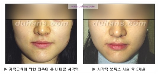 [두한성형외과 경쟁력 안면윤곽 성형 리더] - [완변한 V 라인! 턱 미세지방이식, 볼살 미세지방이식, 사각턱 보톡스 안내] 관련 이미지 37