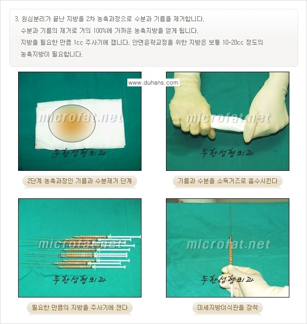 [두한성형외과의 경쟁력 있는 NO.1 지방이식] - [야윈 볼살 미세지방이식] 관련 이미지 9