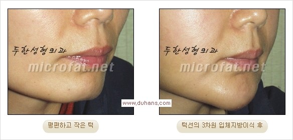 [두한성형외과 경쟁력 미세지방이식] - [부드럽고 아름다운 얼굴윤곽선 턱(하악부) 미세지방이식 안내] 관련 이미지 13