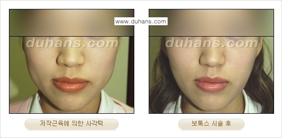[두한성형외과 각진 얼굴을 갸름한 얼굴형으로의 변신] - [사각턱 보톡스] 관련 이미지 10