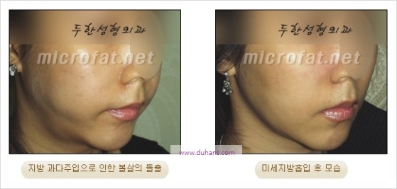 [두한성형외과 경쟁력 지방이식] - [두한 자가지방이식 클리닉 안내]​ 관련 이미지 90