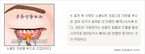 [두한성형외과 경쟁력 "지방제거"] - [눈 지방제거 1.] 관련 이미지 9