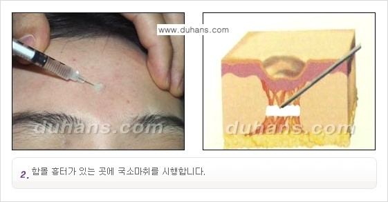 [두한성형외과 함몰 흉터 교정] - [동시에 3가지 시술로 효과적인 흉터의 교정 안내 ①] 관련 이미지 6