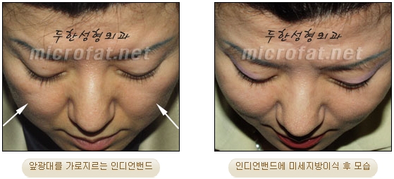 [Duhan Plastic Surgery Face Autologous Fat Grafting] - [Noble Surgery and Indian Band Fat Grafting] image 24