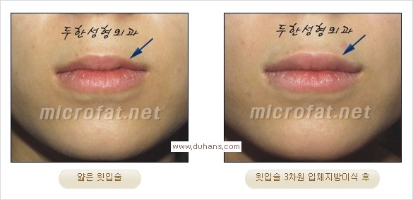 [두한성형외과 경쟁력 미세지방이식] - [입술 3차원 입체지방이식 안내 1.] 관련 이미지 9