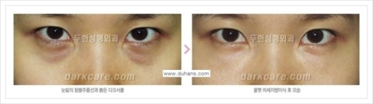 [두한성형외과 경쟁력 눈밑성형] - [눈밑 다크써클 증상과 그 증상에 맞는 치료 방법 안내] 관련 이미지 11