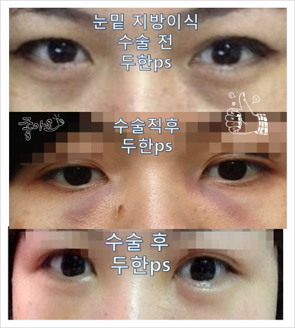 [두한성형외과 다크서클] - [콜펫지방이식] 관련 이미지 19