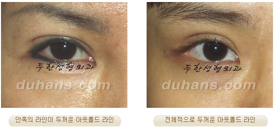Best Place for Revision Eyelid Surgery, Duhan Plastic Surgery - Lowering Double Eyelid Line image 15