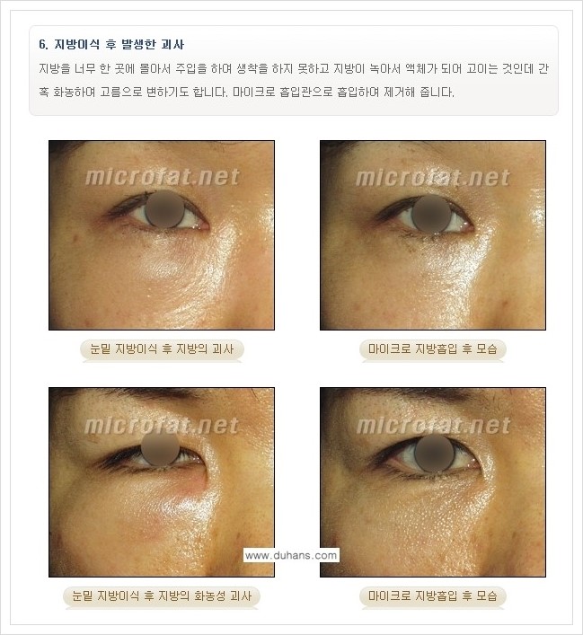 [두한성형외과 경쟁력 지방이식] - [지방이식 부작용 교정 안내 2.] 관련 이미지 13